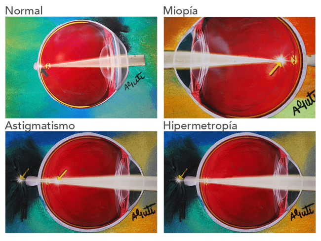 Aberraciones Oculares