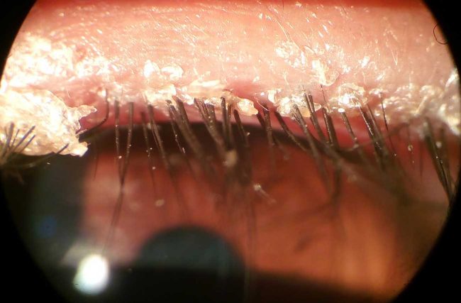 demodex